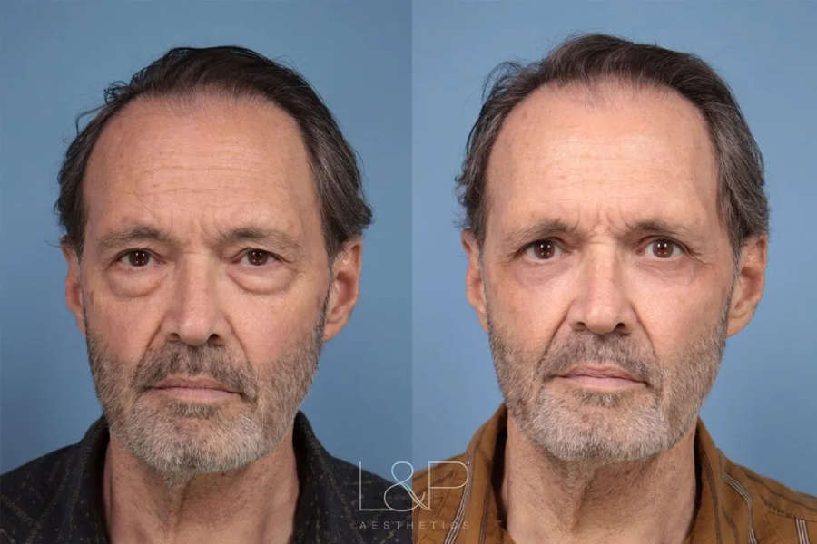 Blepharoplasty